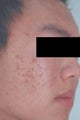 Laser Acne Treatment