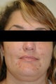 Laser Acne Treatment