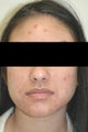 Laser Acne Treatment