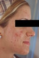 Laser Acne Treatment