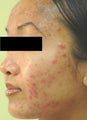Laser Acne Treatment
