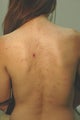 Laser Back Acne Treatment