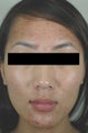 Laser Acne Treatment