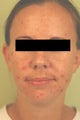 Laser Acne Treatment