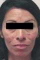 Laser Acne Treatment