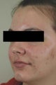 Laser Acne Treatment