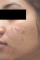 Laser Acne Treatment