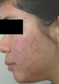 Laser Acne Treatment