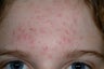 Laser acne treatment with Cooltouch