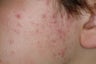 Laser Acne Treatment