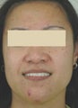 Laser Acne Treatment