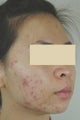 Laser Acne Treatment