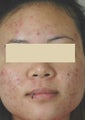 Laser Acne Treatment