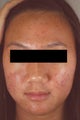 Laser Acne Treatment