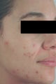 Acne Laser Treatment