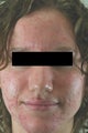 Acne Laser Treatment