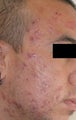 Acne Laser Treatment