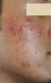 Laser Acne Treatment