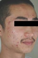 Acne Laser Treatment