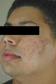 Acne Laser Treatment