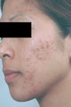 Acne Laser Treatment