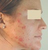 Acne Laser Treatment