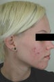 Acne Laser Treatment