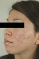 Acne Laser Treatment