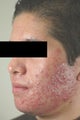 Laser Acne Treatment