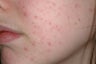 Acne treatment