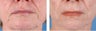 Active FX Fractional Laser Resurfacing