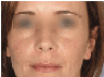 active fx fractional resurfacing