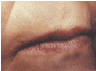 active fx fractional Co2 resurfacing