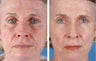 Active FX Fractional Laser Resurfacing