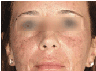 active fx fractional resurfacing