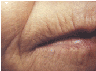 active fx fractional Co2 resurfacing