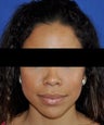 African American Rhinoplasty