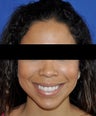 African American Rhinoplasty