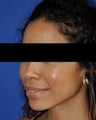 African American Rhinoplasty