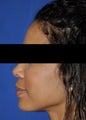 African American Rhinoplasty