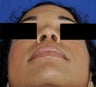African American Rhinoplasty