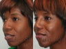 African American Rhinoplasty