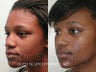 African American Rhinoplasty