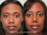African American Rhinoplasty