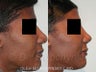 African American Rhinoplasty