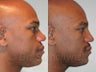African American Rhinoplasty
