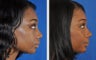 African American Ethnic Rhinoplasty
