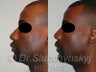 Ethnic-African American Rhinoplasty