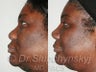 African American Rhinoplasty