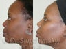 African American Rhinoplasty